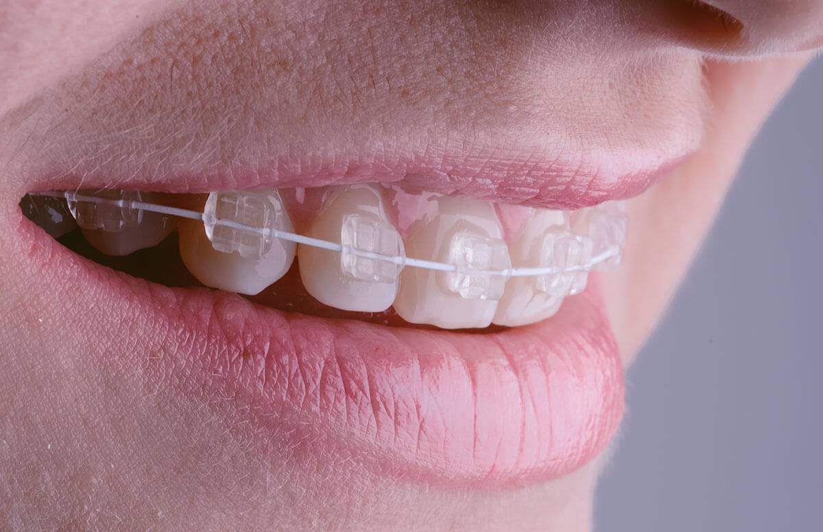 Do Clear Braces Work? Everything to Know for New Users