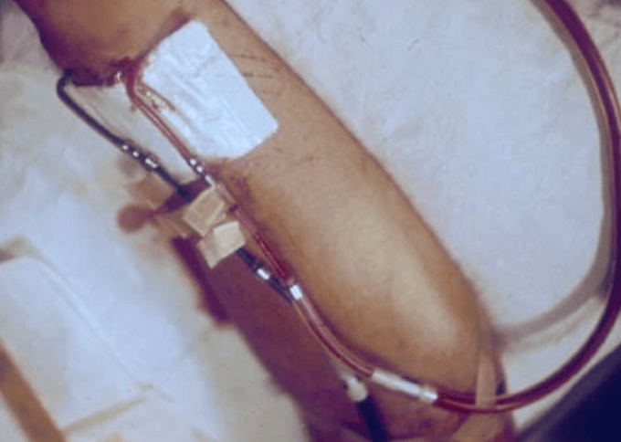 Close up of dialysis patient's arm, with IVs.