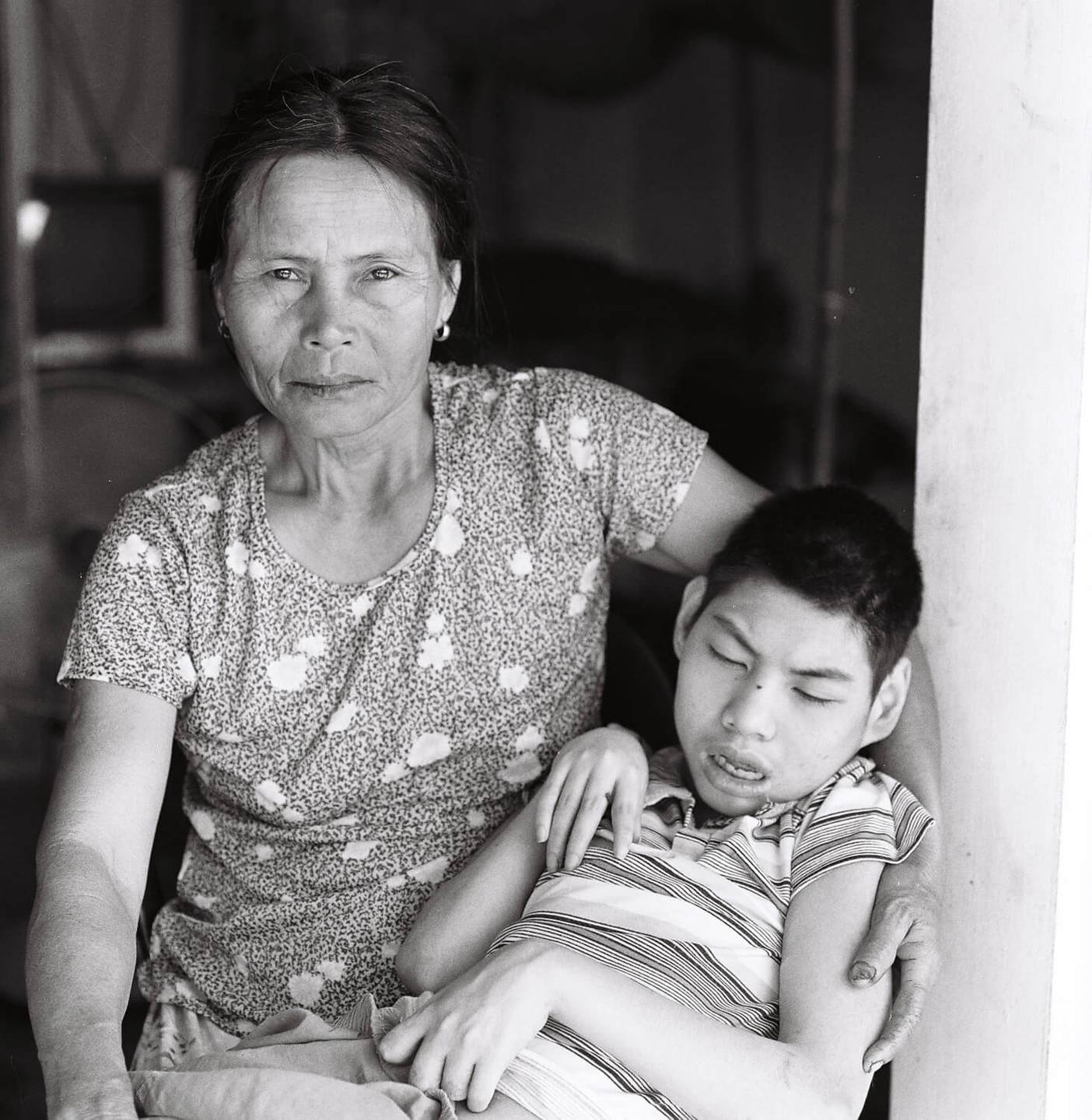 An Asian mother holding her deformed son, looking intensely into the camera.