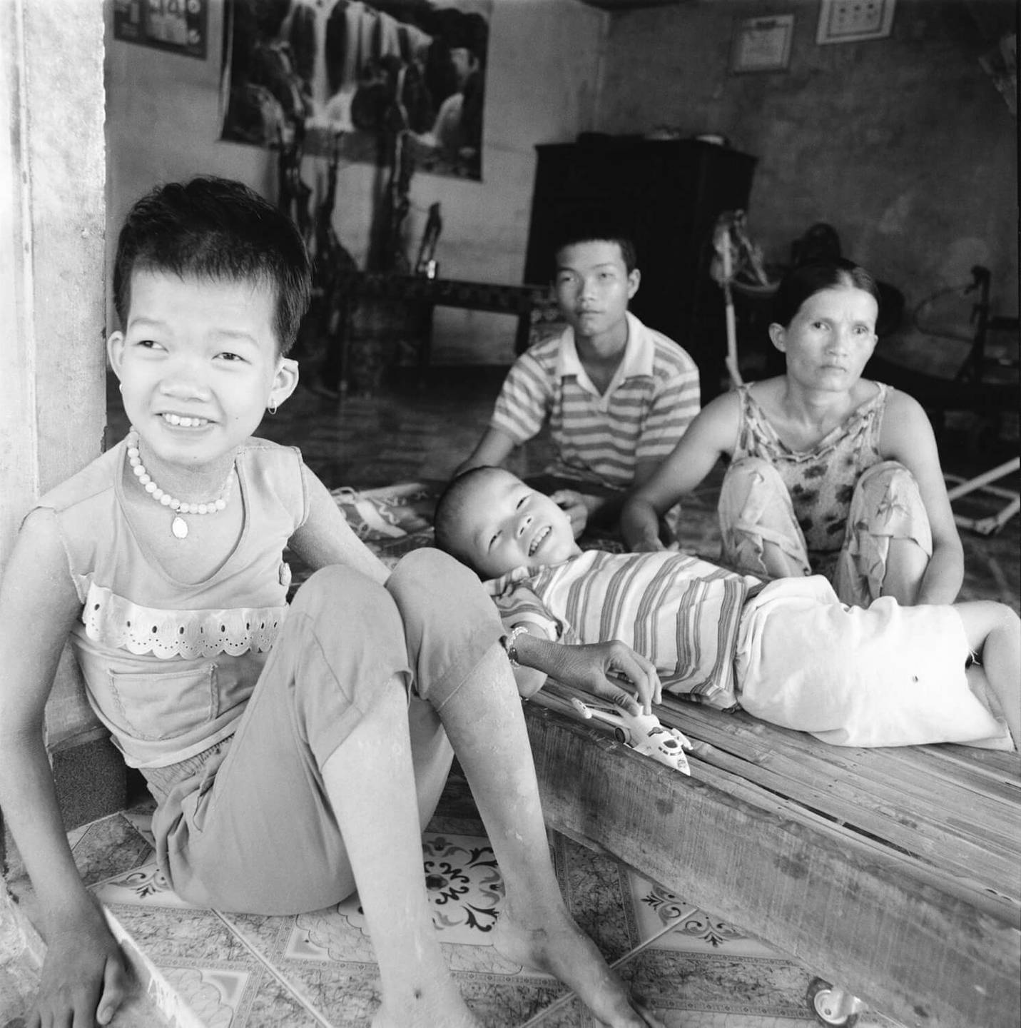 Two deformed Asian children, one seated, one lying down, with two adults.