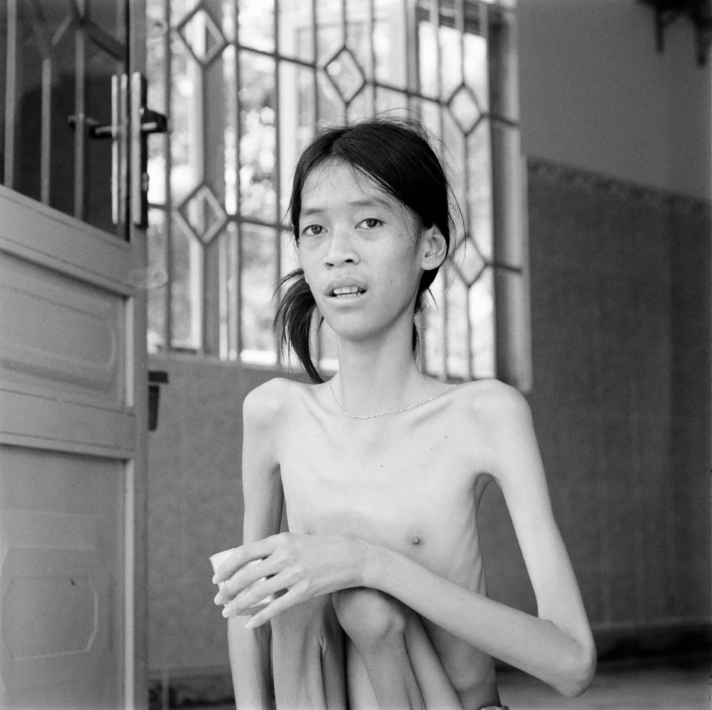 A deformed Asian child, seated with her thin, frail legs against her chest.
