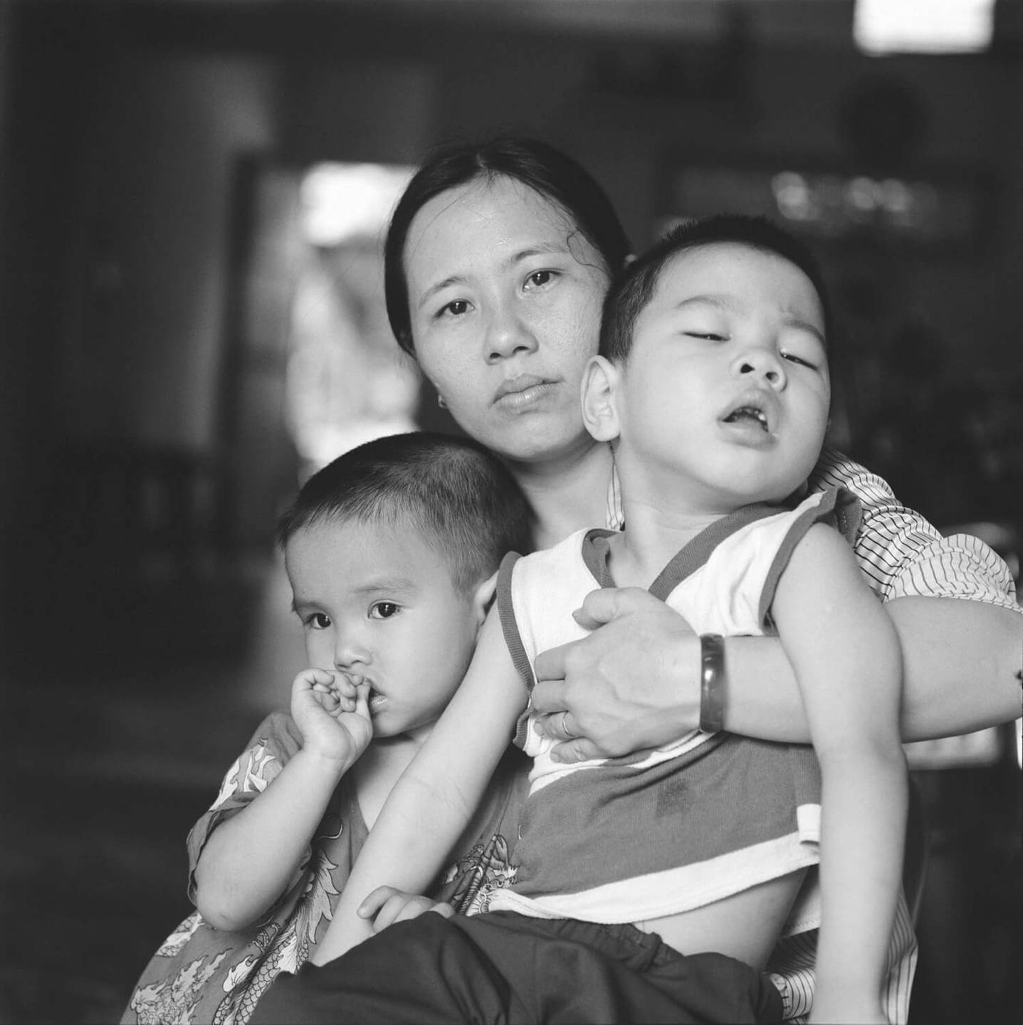 Young Asian mother holding her two children, one who is deformed.